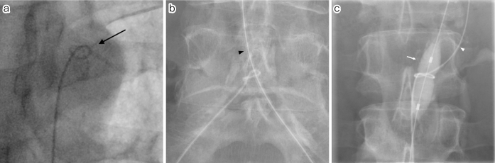 Untangling a Knotted Angiographic Catheter Using a Balloon Catheter: A Case Report.