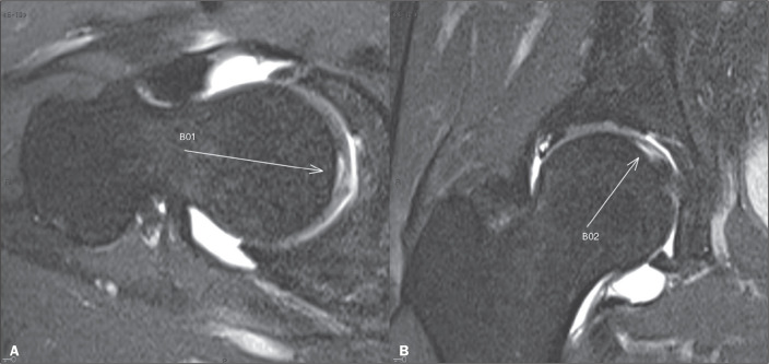 Parafoveal chondral lesion of the femoral head in patients with femoroacetabular impingement.