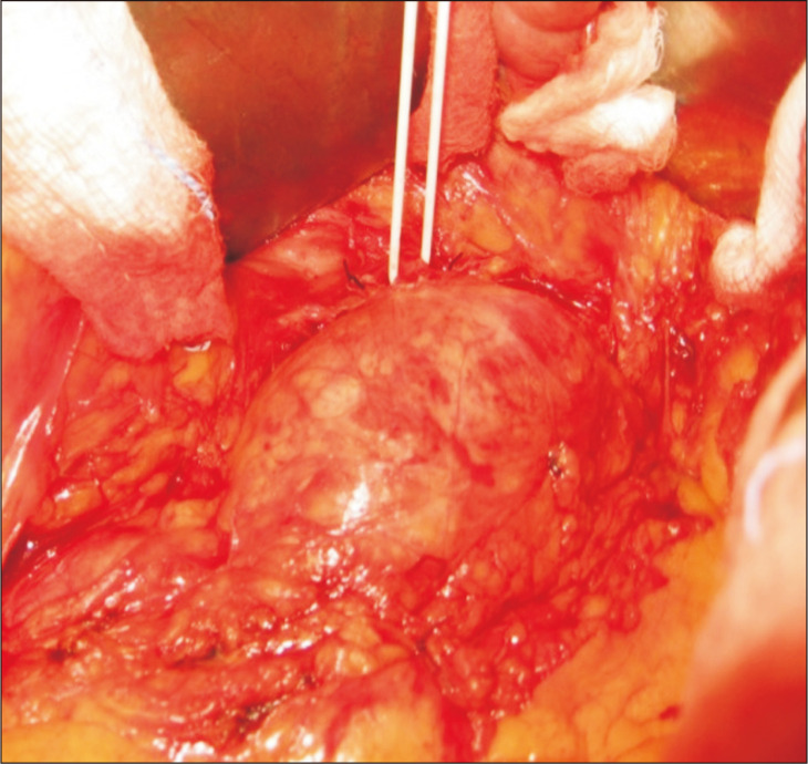 Surgical Considerations for the Management of an Ectopic Main Renal Artery Originating from an Abdominal Aortic Aneurysm.