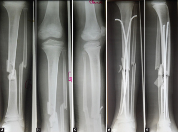 Treatment of long bone fractures in children by elastic stable intramedullary nailing: Outcome and challenges in a unit with restricted technical platform.