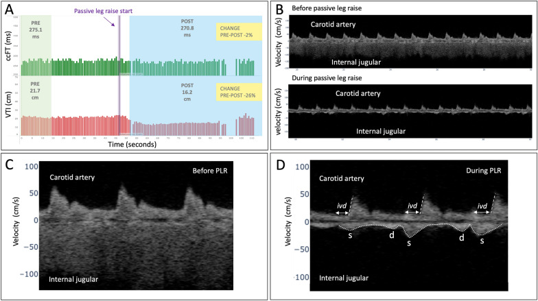 Simultaneous venous-arterial Doppler during preload augmentation: illustrating the Doppler Starling curve.