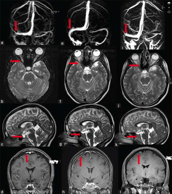 The ebb and flow of headache: A clue to pathophysiology of sinus stenosis in idiopathic intracranial hypertension?