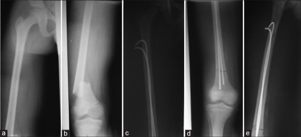 Treatment of long bone fractures in children by elastic stable intramedullary nailing: Outcome and challenges in a unit with restricted technical platform.