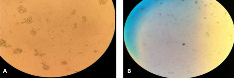 The Effect of the Persian Gulf Jellyfish (Cassiopea andromeda) Venom on the Expression of P15, P21, P53, DNMT1, and Bcl-2 in Acute Lymphoblastic Leukemia Jurkat Cells.