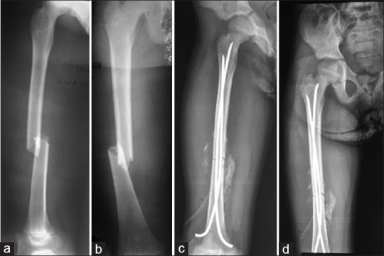 Treatment of long bone fractures in children by elastic stable intramedullary nailing: Outcome and challenges in a unit with restricted technical platform.