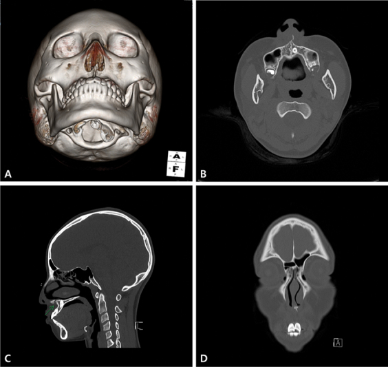 Open Reduction of an Isolated Anterior Nasal Spine Fracture: A Case Report and Review of the Literature.