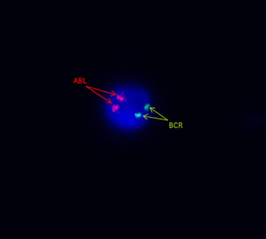 Investigating residual leukemic cells in acute lymphoblastic leukemia: a practical approach using a streamlined interphase fluorescence in situ hybridization method on cerebrospinal fluid.