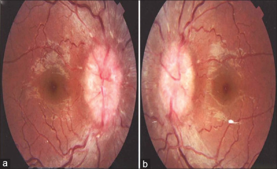 The ebb and flow of headache: A clue to pathophysiology of sinus stenosis in idiopathic intracranial hypertension?