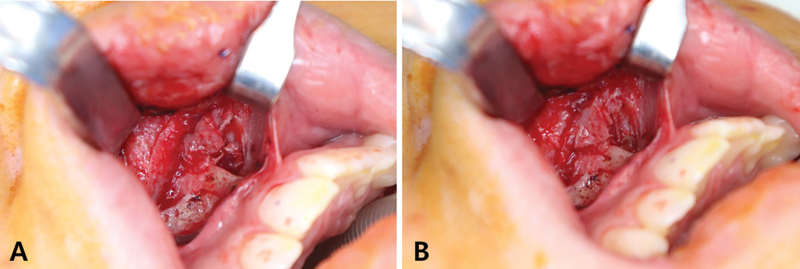 Open Reduction of an Isolated Anterior Nasal Spine Fracture: A Case Report and Review of the Literature.