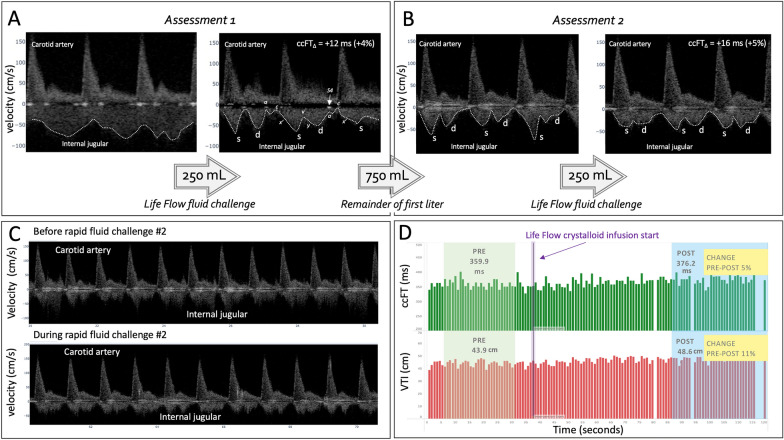 Simultaneous venous-arterial Doppler during preload augmentation: illustrating the Doppler Starling curve.