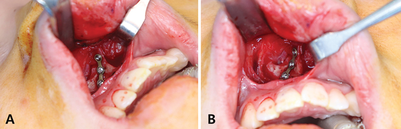 Open Reduction of an Isolated Anterior Nasal Spine Fracture: A Case Report and Review of the Literature.