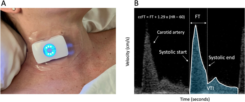 Simultaneous venous-arterial Doppler during preload augmentation: illustrating the Doppler Starling curve.