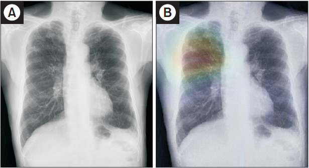 Chest Radiography of Tuberculosis: Determination of Activity Using Deep Learning Algorithm.