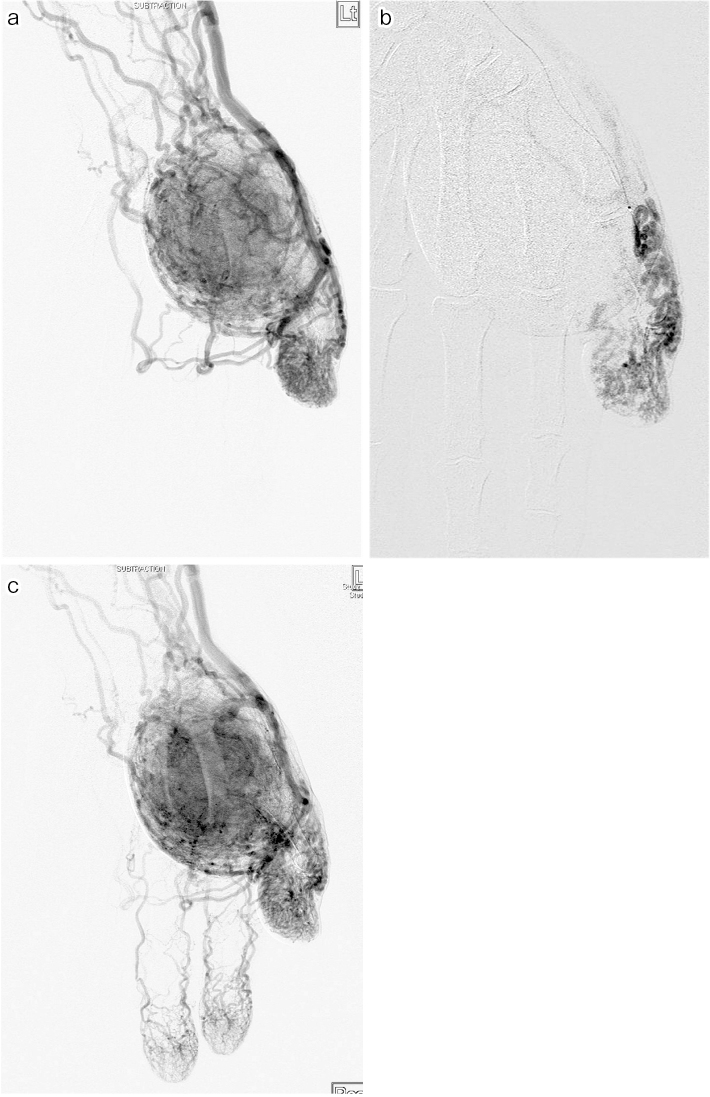 Endovascular and Percutaneous Embolotherapy for the Body and Extremity Arteriovenous Malformations.