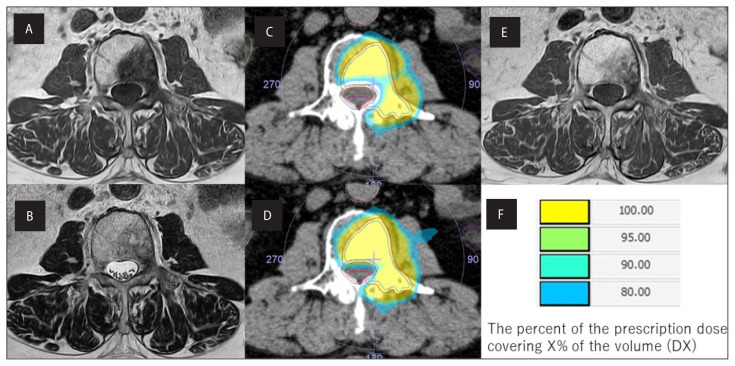 Stereotactic body radiation therapy to the spine: contouring the cauda equina instead of the spinal cord is more practical as the organ at risk.