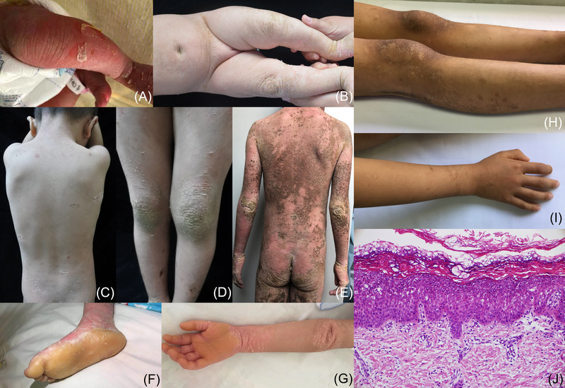 Clinical and genetic findings in 13 Chinese children with keratinopathic ichthyosis.