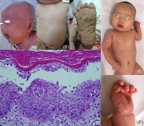 Clinical and genetic findings in 13 Chinese children with keratinopathic ichthyosis.