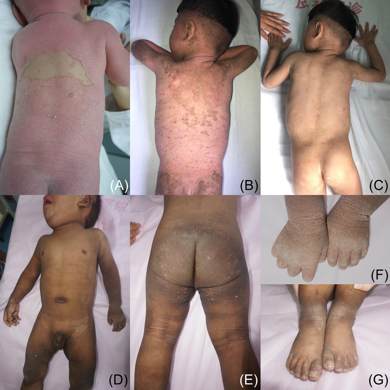 Clinical and genetic findings in 13 Chinese children with keratinopathic ichthyosis.