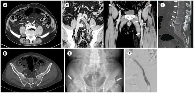 CT Findings of May-Thurner Syndrome in Diffuse Idiopathic Skeletal Hyperostosis: A Case Report.