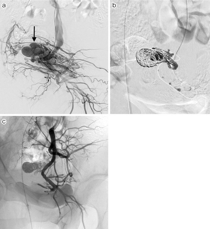 Endovascular and Percutaneous Embolotherapy for the Body and Extremity Arteriovenous Malformations.