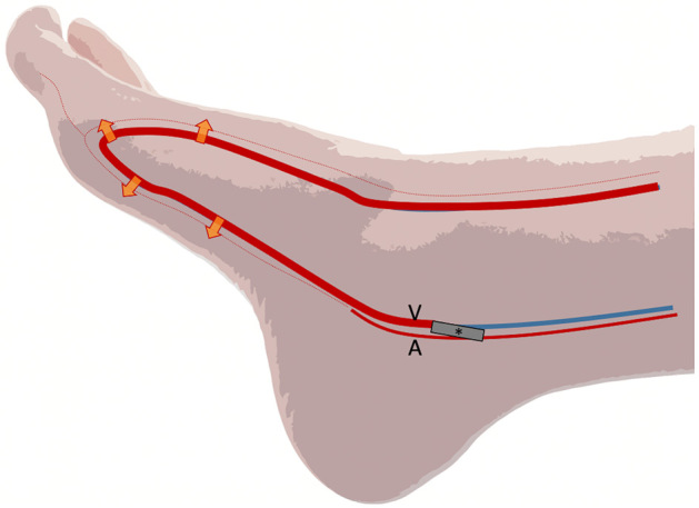 Role of Percutaneous Deep Venous Arterialization for Patients with Chronic Limb-threatening Ischemia.