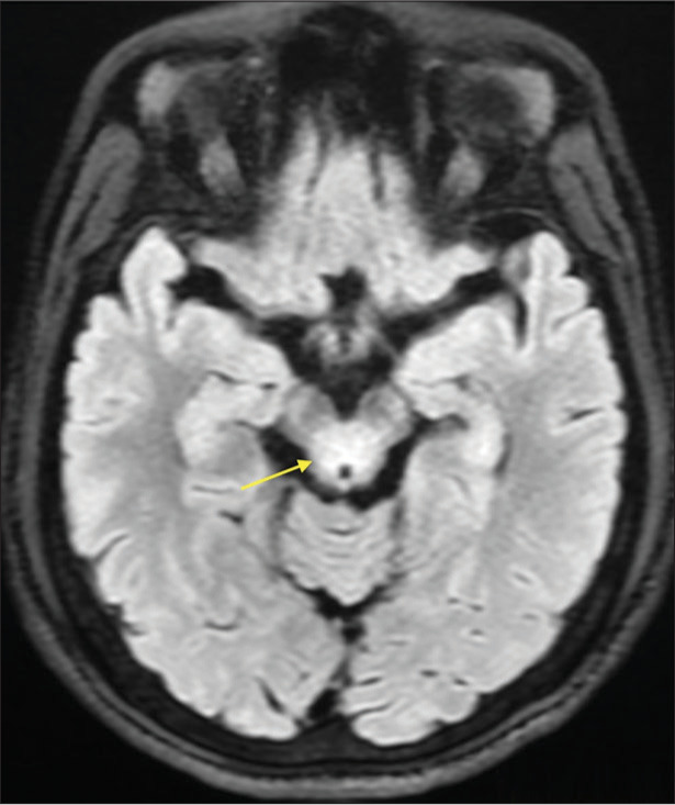 Wing beating tremors in Wilson's disease: An important clinical clue.