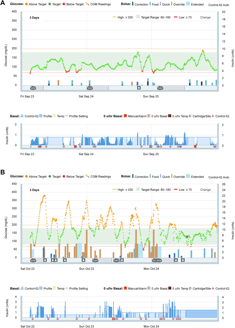 Hyperglycemia Associated With Raynaud Phenomenon and Liver Dysfunction After COVID-19 Vaccination in Type 1 Diabetes Mellitus