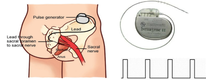 Therapeutic potential and mechanisms of sacral nerve stimulation for gastrointestinal diseases.