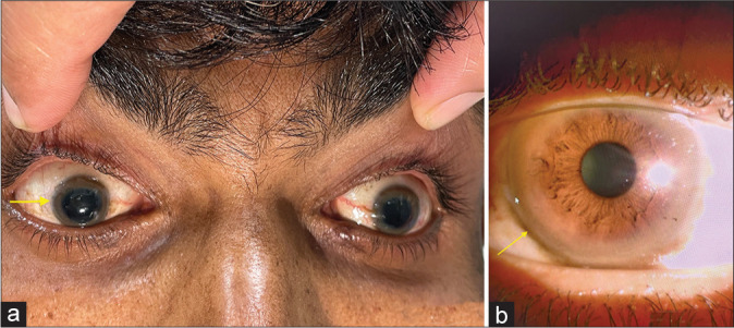 Wing beating tremors in Wilson's disease: An important clinical clue.