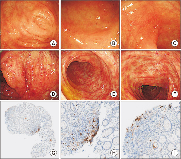 Proven Cytomegalovirus Colitis Associated with Dasatinib Administration in Two Pediatric Allogeneic Hematopoietic Stem Cell Transplantation Recipients.