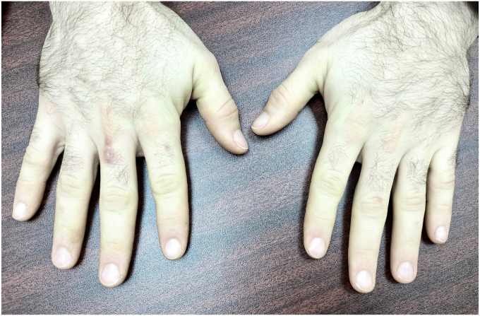 Hyperglycemia Associated With Raynaud Phenomenon and Liver Dysfunction After COVID-19 Vaccination in Type 1 Diabetes Mellitus