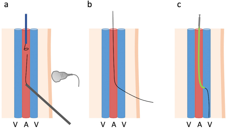 Role of Percutaneous Deep Venous Arterialization for Patients with Chronic Limb-threatening Ischemia.