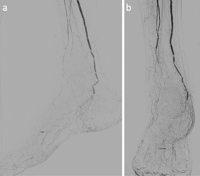 Role of Percutaneous Deep Venous Arterialization for Patients with Chronic Limb-threatening Ischemia.