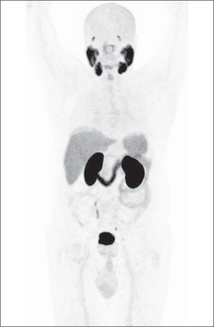 Musculoskeletal pitfalls in <sup>68</sup>Ga-PSMA PET/CT.