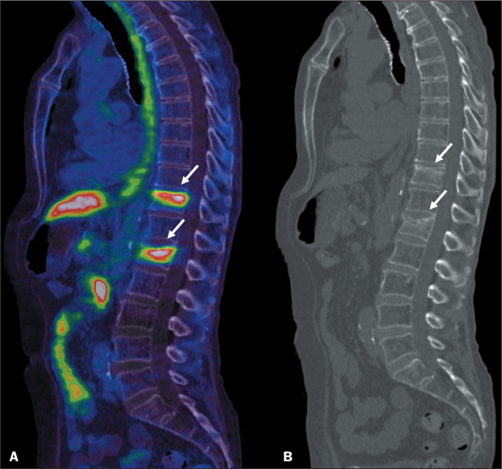 Musculoskeletal pitfalls in <sup>68</sup>Ga-PSMA PET/CT.