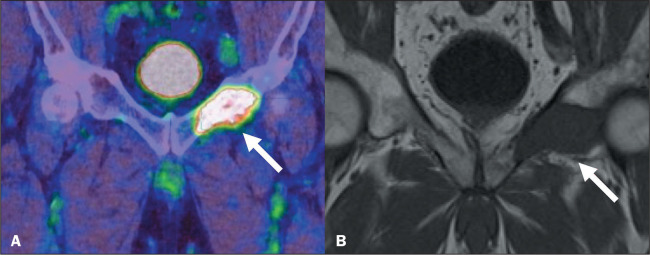 Musculoskeletal pitfalls in <sup>68</sup>Ga-PSMA PET/CT.