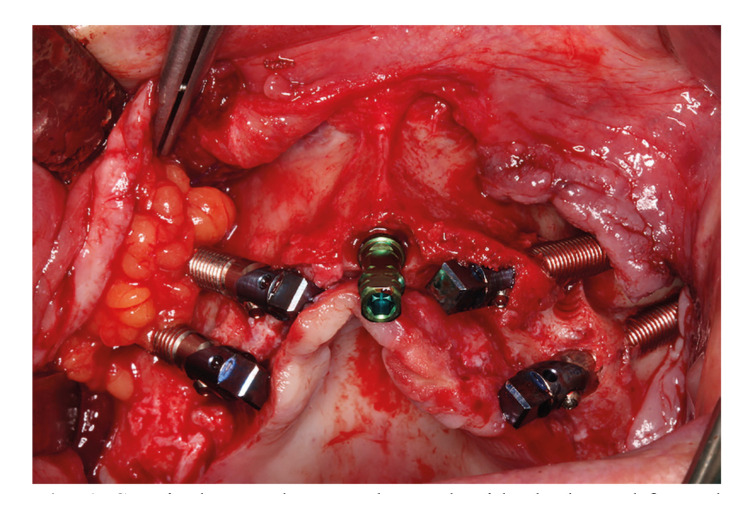 Effect of the buccal fat pad in the prevention of zygomatic implant surgery postoperative complications: A pilot study.