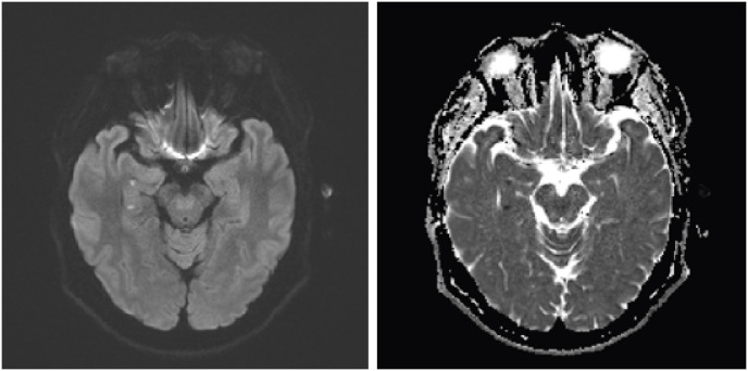 Dot-Like Hippocampal Hyperintensities on Diffusion-Weighted MRI in a Patient With Vomiting Caused by Benign Paroxysmal Positional Vertigo Without Amnesia.