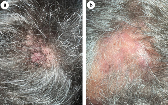 Efficacy and Safety of Carbon Dioxide Laser System in the Treatment of Scalp Sebaceous Adenoma With the Use of a New Scanner Unit.