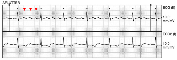 Fluid Overload-Associated Large B-Cell Lymphoma: A Case Report and Review of Literature.