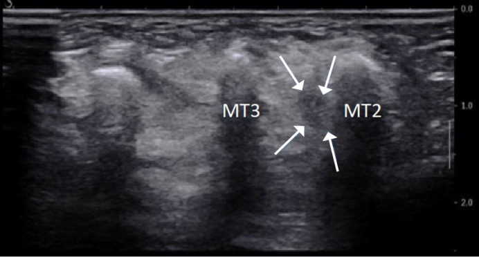 Nerve entrapment syndromes: detection by ultrasound.