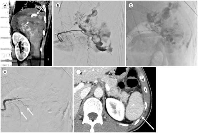 [Clinical Role of Interventional Radiology in Abdominal Solid Organ Trauma].