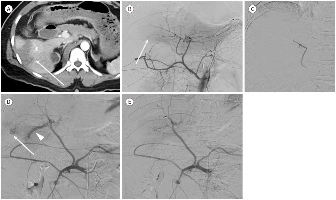 [Clinical Role of Interventional Radiology in Abdominal Solid Organ Trauma].