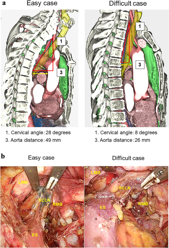 Predictors of the difficulty of transcervical subcarinal lymph node dissection for esophageal cancer.