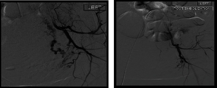 Hysterectomy Sparing Management of Uterine Necrosis following Uterine Artery Embolization for Postpartum Hemorrhage.