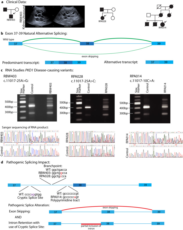 Atypical splicing variants in PKD1 explain most undiagnosed typical familial ADPKD.