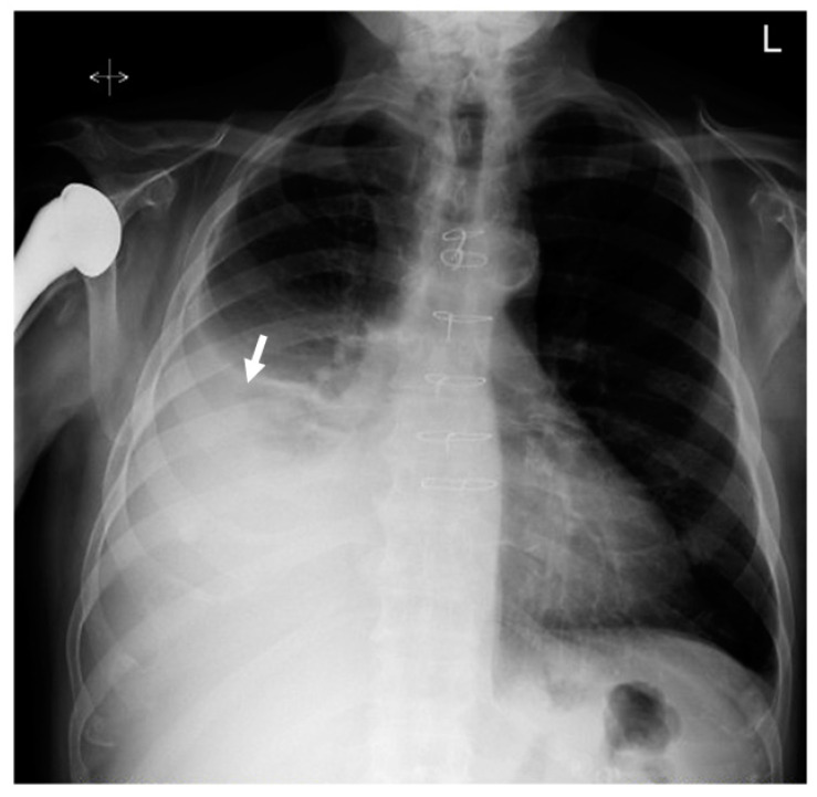 Fluid Overload-Associated Large B-Cell Lymphoma: A Case Report and Review of Literature.