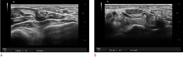 Nerve entrapment syndromes: detection by ultrasound.