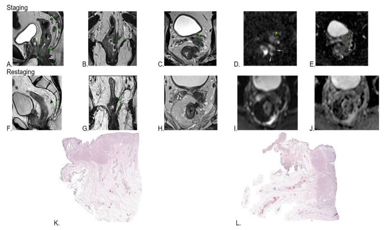 Preoperative MRI accuracy after neoadjuvant chemoradiation for locally advanced rectal cancer.