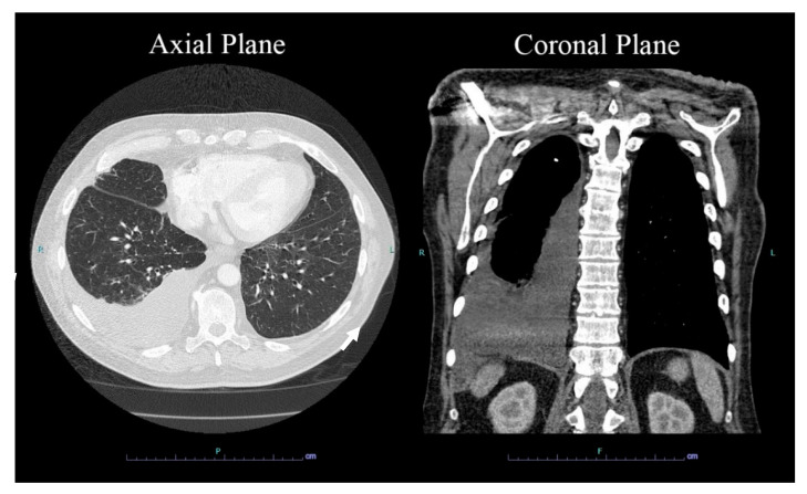 Fluid Overload-Associated Large B-Cell Lymphoma: A Case Report and Review of Literature.